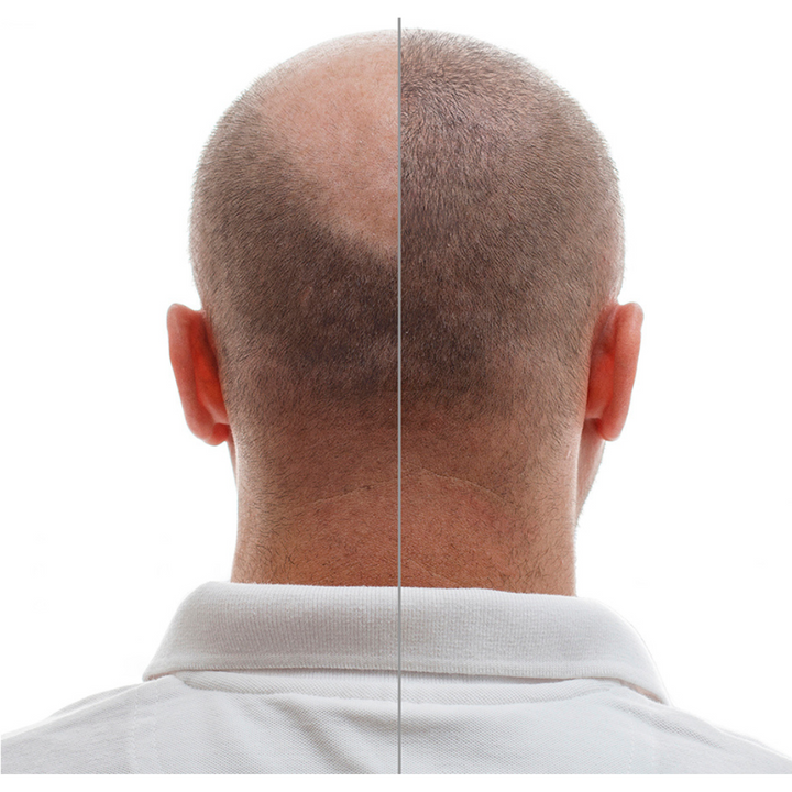 MINOXIDIL 5MG 60 CAPSULAS