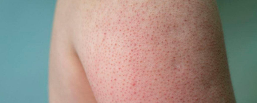 Piel de fresa: cómo eliminar los granitos en brazos y piernas con productos de farmacia