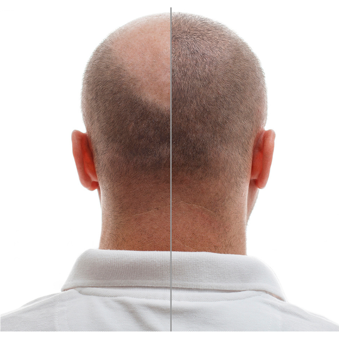 NEOLABMA MINOXIDIL 5MG 60 CAPSULAS